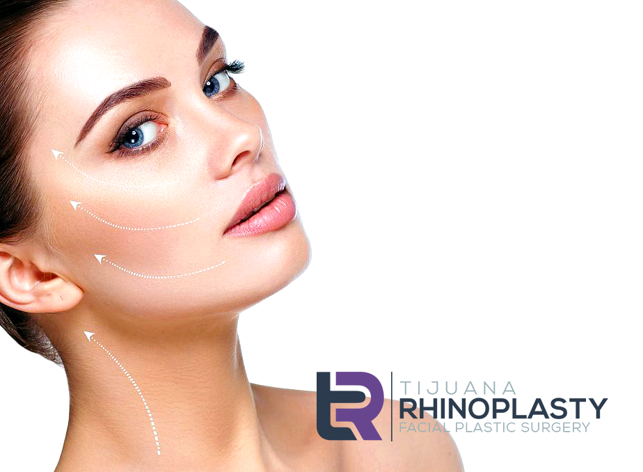 At Tijuana Rhinoplasty, a neck lift, or rhytidectomy, reduces or eliminates the visible signs of aging in the jawline and neck.