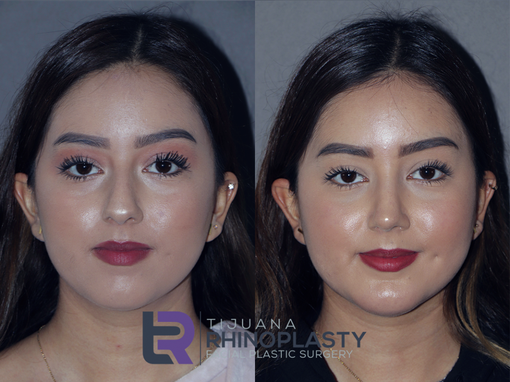 View rhinoplasty before and after photos results from Dr. Edgar Eduardo Santos, board certified facial plastic surgeon in Tijuana, Mexico.