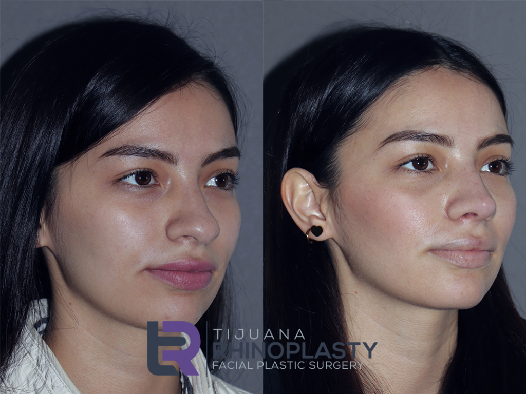 View rhinoplasty before and after photos results from Dr. Edgar Eduardo Santos, board certified facial plastic surgeon in Tijuana, Mexico.