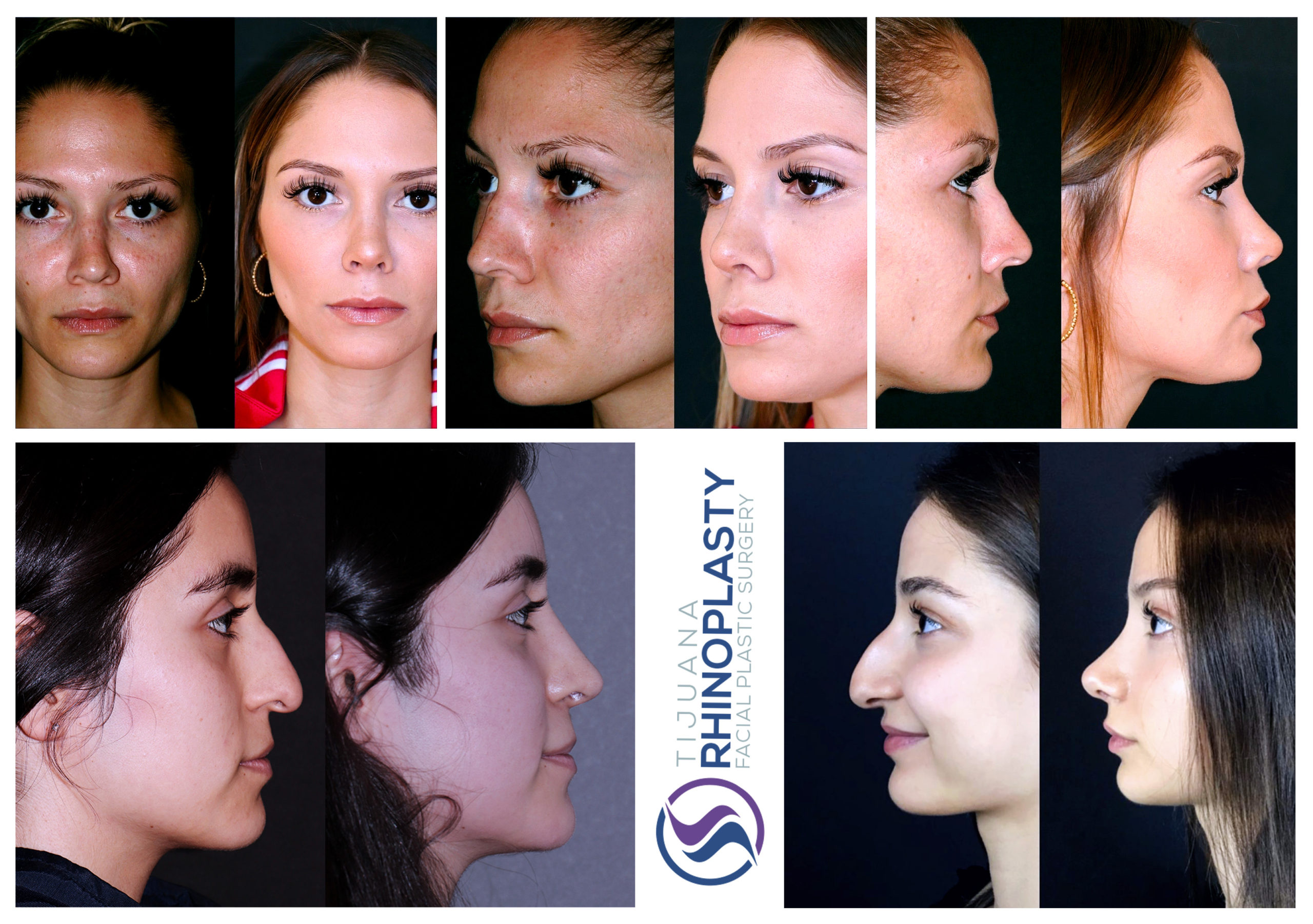 Tijuana Rhinoplasty in Tijuana, Mexico, is dedicated exclusively to facial plastic surgery. Dr. Edgar Eduardo Santos specializes in a wide variety of facial cosmetic and reconstructive procedures, including rhinoplasty and revision rhinoplasty.