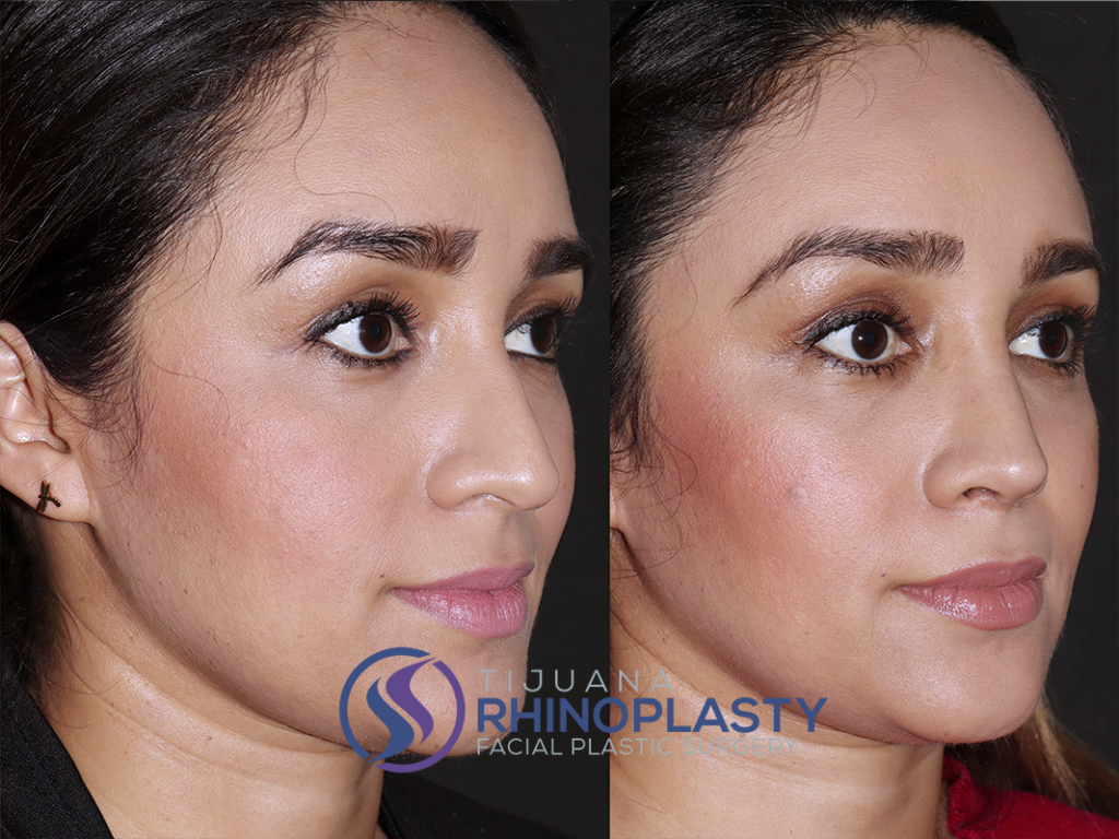 Rhinoplasty before and after photos results from Dr. Edgar Eduardo Santos, board certified facial plastic surgeon in Tijuana, Mexico.