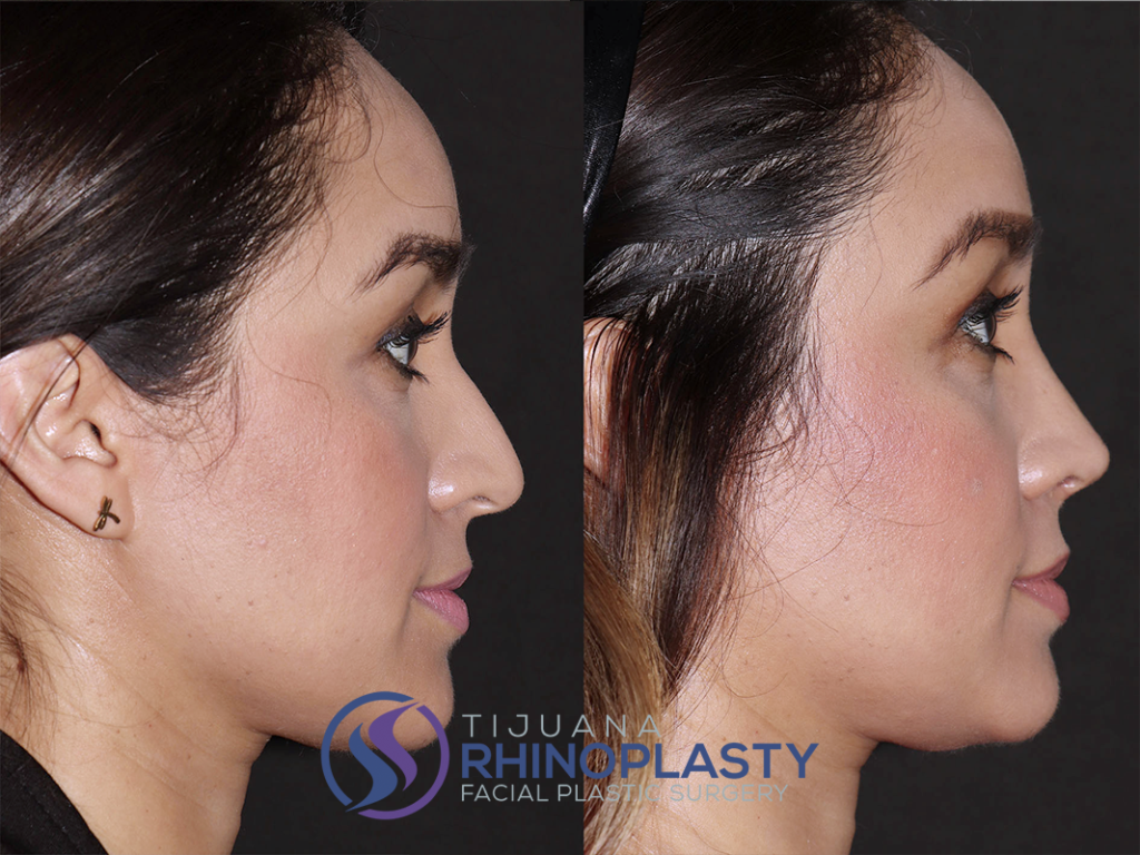 Rhinoplasty before and after photos results from Dr. Edgar Eduardo Santos, board certified facial plastic surgeon in Tijuana, Mexico.