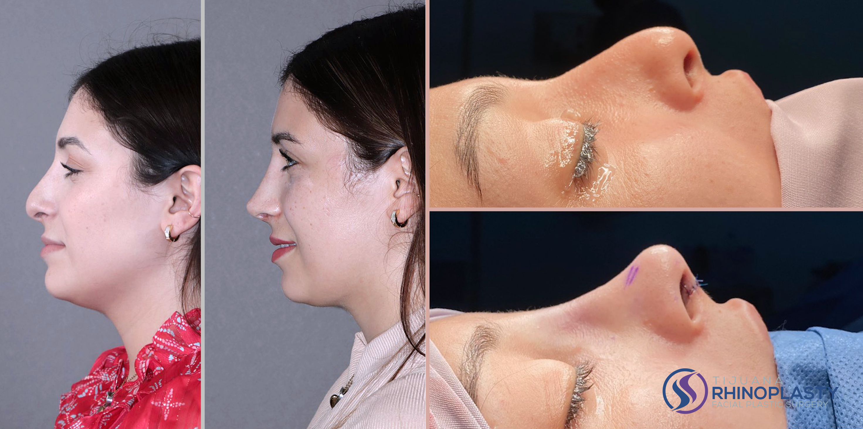 Tijuana Rhinoplasty offers facial plastic surgery procedures to reshape structures in the head and neck — typically the nose, ears, chin, cheekbones and neckline.