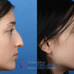 The average cost of rhinoplasty surgery at Tijuana Rhinoplasty is a representation of Dr. Edgar Santos training, expertise, and surgical history.