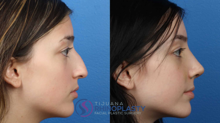 The average cost of rhinoplasty surgery at Tijuana Rhinoplasty is a representation of Dr. Edgar Santos training, expertise, and surgical history.