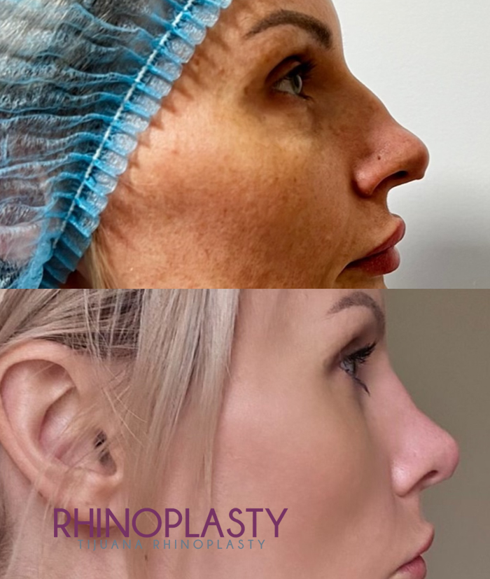 Considering rhinoplasty surgery in Mexico? Here is everything you need to know. Rhinoplasty improves the form and function of your nose.